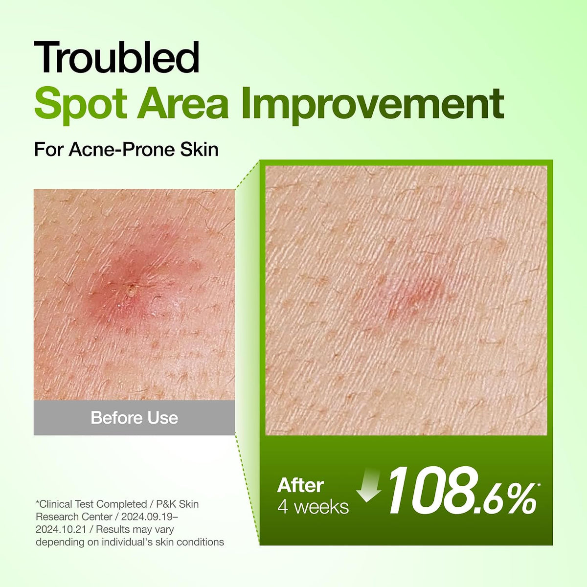 [ANUA] Azelaic Acid 10+ Hyaluron Soothing Serum 30ml