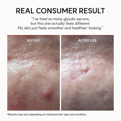 [ARENCIA] Eraser Shot Glycolic Acid Booster, Daily Clarifying Multi-Acid Formula for Smoother, Clear-Looking Skin 30ml